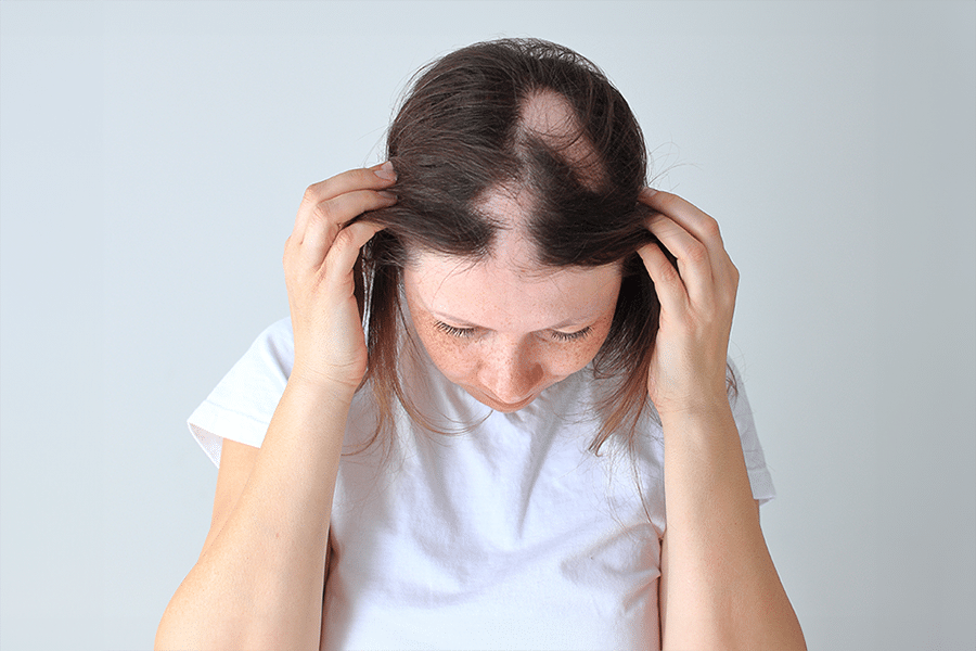 alopecia