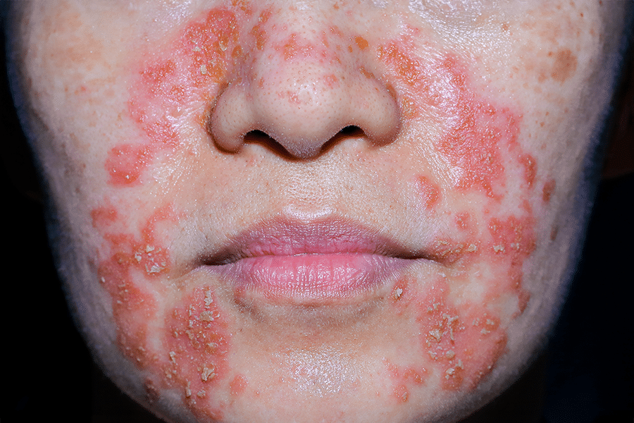 seborrheic dermatitis